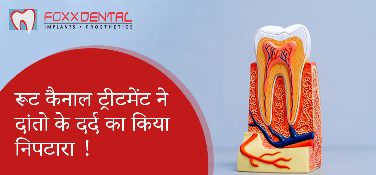 रूट कैनाल ट्रीटमेंट ने दांतो के दर्द का किया निपटारा ! (1)