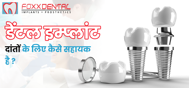 डेंटल-इम्प्लांट-दांतों-के-लिए-कैसे-सहायक-है