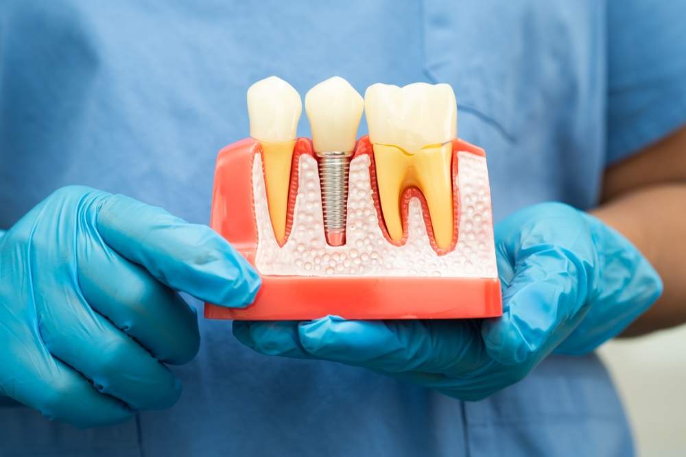 Best dental implant clinic in ludhiana