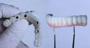 All-on-4 Dental Implants