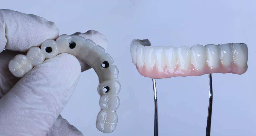 All-on-4 Dental Implants